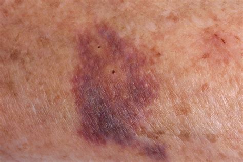 Elderly skin bruising: What may be going on - Seasons