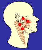 Parotid Lymph Node Metastases