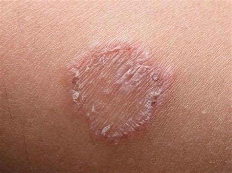 Ringworm Pictures Causes And Symptoms How Does It Look Like | Images and Photos finder