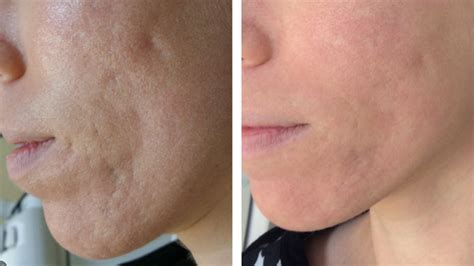 Acne Scar Treatment Norfolk, VA – Edgewater Aesthetics | The Premier Norfolk Med Spa