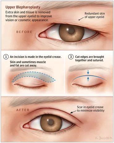 Sagging Eye Syndrome: Causes, Symptoms, Diagnosis & Treatment - Daily Medicos | Хирургия ...