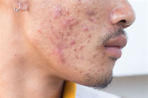 Stryx | What is Fungal Acne? Causes, Treatments, & Symptoms