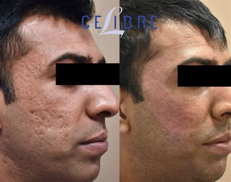 Acne Scar Removal Before and After Pictures of Actual Patients