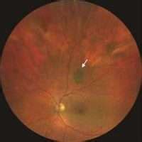 Choroidal Nevus : Symptoms & Treatment | Windy City Retina