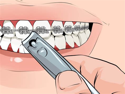 How to Fix a Broken Braces Wire: 6 Steps (with Pictures) - wikiHow