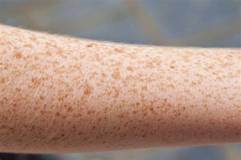 Skin Lesions: Pictures, Types, Causes, Treatment