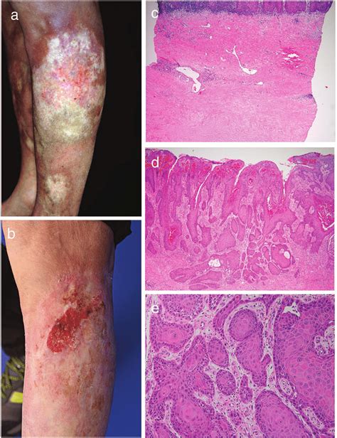 Development of cutaneous squamous cell carcinoma (cSCC) in a ...