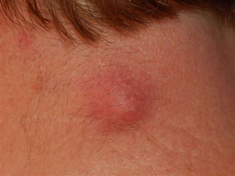 Large Lump On Neck | Images and Photos finder