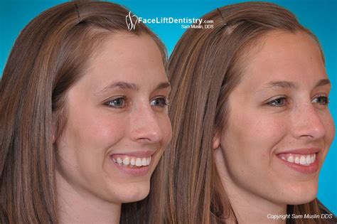 Receding Chin and Misaligned Jaw Corrected in 2-Weeks | Chin augmentation, Chin, Cleft chin