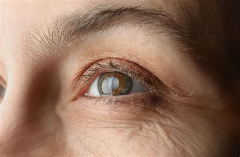 What Is Narrow-Angle Glaucoma? | Winnipeg