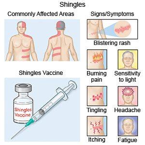 Shingles - What You Need to Know