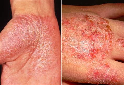 Plaque Psoriasis Vs Eczema