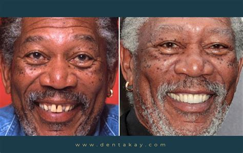 6 Shocking celebrity veneers with before & after pictures