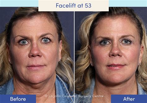 Facelift Before & After Photos: What a Facelift Looks Like at 40, 50, 60 & 70 | Facelift in San ...