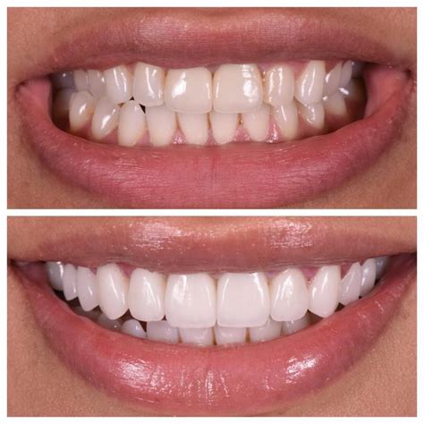 Dental Veneers – Dental Implants Cape Town