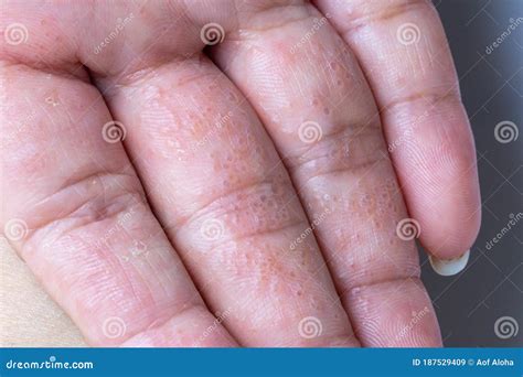 Close Up Atopic Dermatitis on FingerAD, Also Known As Atopic Eczema.Skin Disease Concept. Stock ...