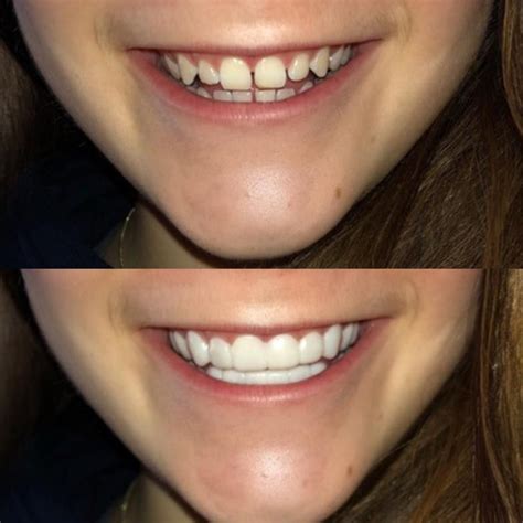 Non-surgical veneers are the PERFECT way to achieve a Hollywood smile ...