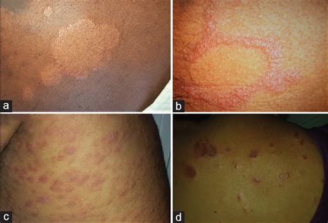 Leprosy Skin Lesions - Find Any Infos Here | Masezza