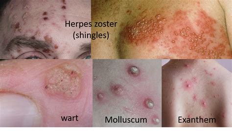 Viral skin infections