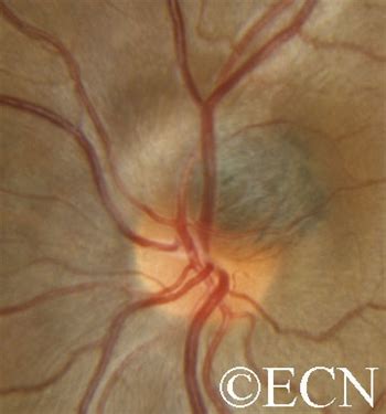 Optic Nerve Melanocytoma Archives » New York Eye Cancer Center