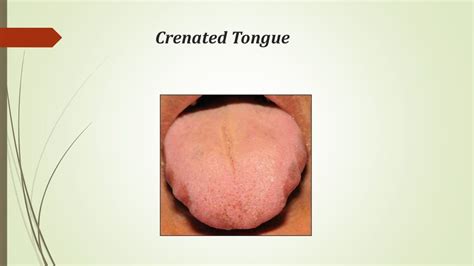 Diseases of lips & tongue