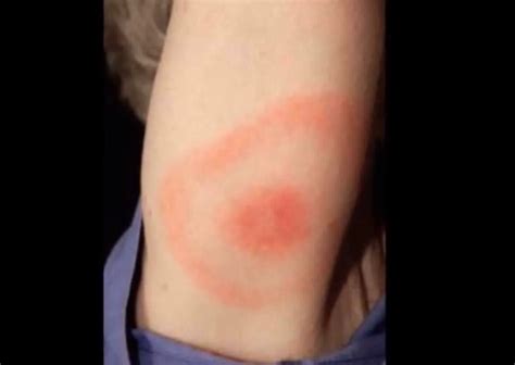 Brown Recluse Bite: Pictures, Stages, Signs & Treatment - YouMeMindBody