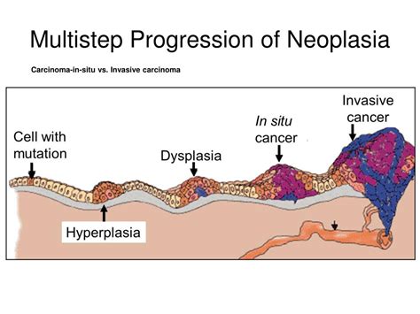 PPT - Multistep Progression of Neoplasia PowerPoint Presentation, free download - ID:3378785