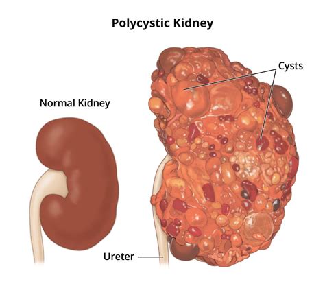 Polycystic Kidney Disease Pathophysiology