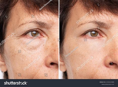 9,907 Wrinkles Face Before After Images, Stock Photos, 3D objects, & Vectors | Shutterstock