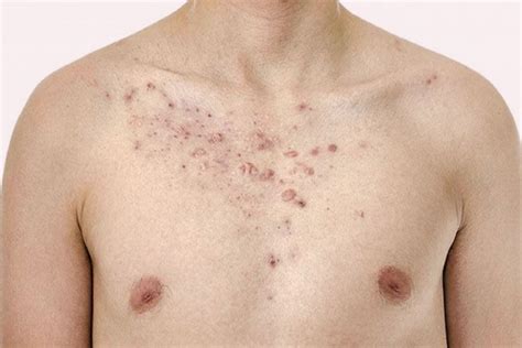 Chest Acne : Causes, Treatment and Prevention