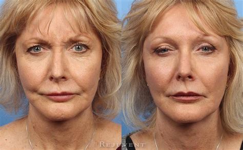 Botox Before And After