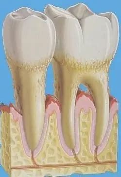 Methods and stages of treatment of periodontitis | Dentistry 2024