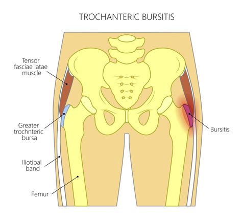 9 Best Exercises For Hip Bursitis (Video Included)