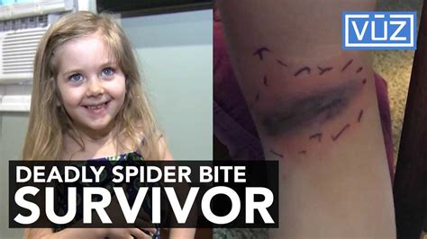 Girl hospitalized after black widow spider bite