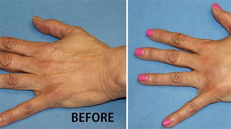 Hand Lift Surgery - Lift Choices