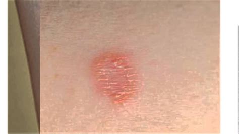 fjkdtktykt: 9 Fungal Skin Rash Treatment Evidence based management of atopic eczema