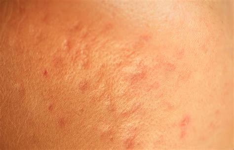 How To Remove Chickenpox Scars From The Skin