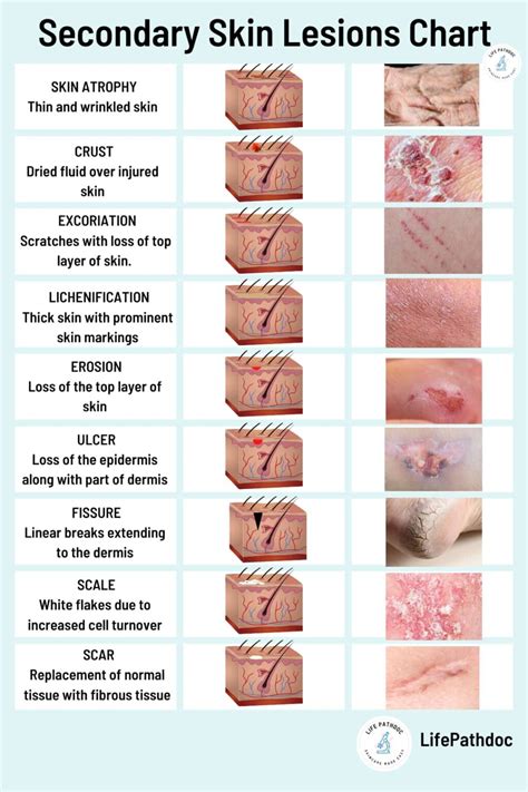 Skin Lesions: Types with Chart, Pictures, Causes, Treatment