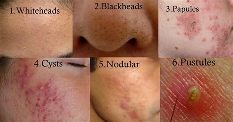 Types of Acne | Back acne treatment, Diy acne treatment, Cystic acne treatment