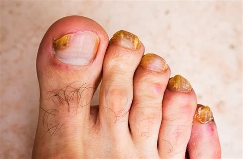 Brown Spot on the Toenail: Causes and Treatment – NailDesignCode