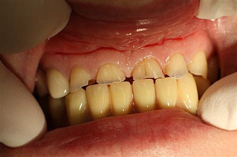 Dental Erosion from Abrasion & Abfraction | Postgraduate Dentistry