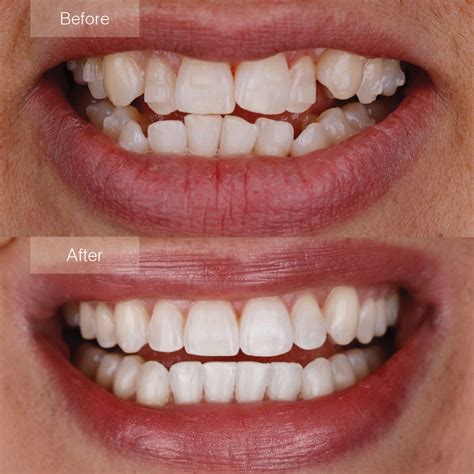 Invisalign Before And After Crowding