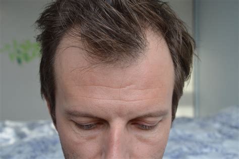 TELOGEN EFFLUVIUM: HAIR LOSS IN RESPONSE TO TRAUMA