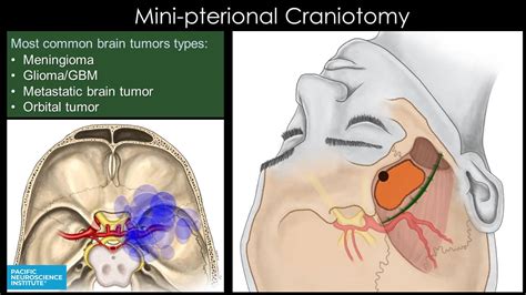 Minimally Invasive Brain Surgery | Keyhole Craniotomy | Pacific Brain Tumor Center