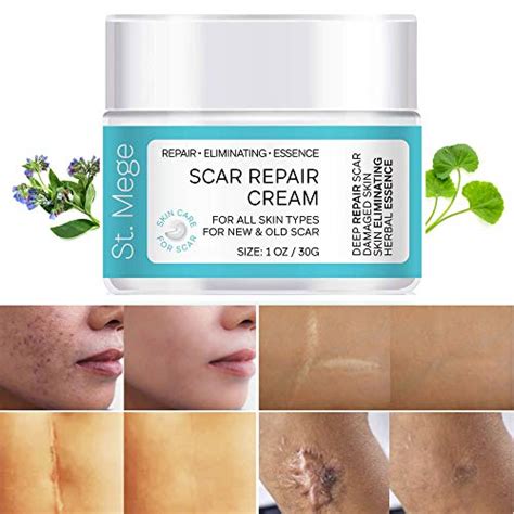 The 12 Best Scar Creams in 2021 - Top Picks & Buying Guide