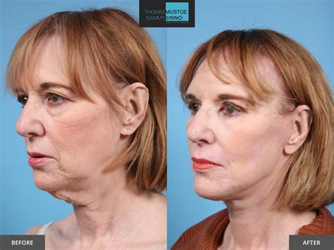 8 Facelift Before-and-After Photos That Prove Just How Natural Today’s Results Look | TLKM ...