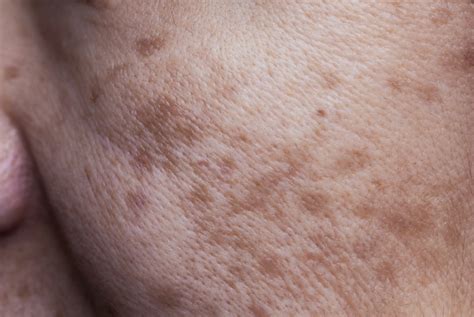 Skin Concerns - Pigmentation - D.Thomas Clinic