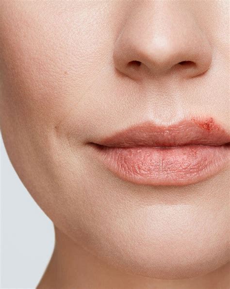 Cold Sore Stages | Abreva