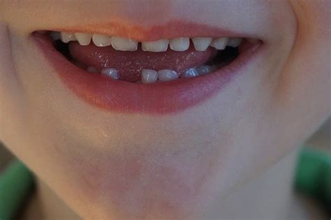 Loose Tooth: Causes And Treatment | 25 Doctors