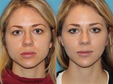 BOTOX® Cosmetic Before and After Photo Gallery | Atlanta, Georgia | Buckhead Facial Plastic Surgery